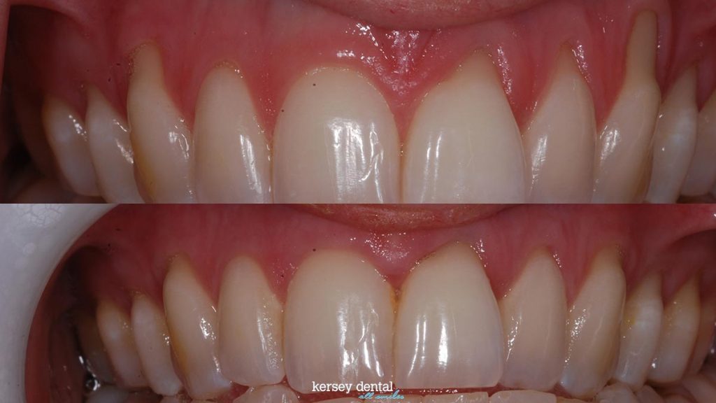 Before After Photos Kersey Dental