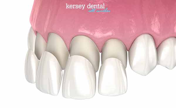 graphic-showing-veneers-process